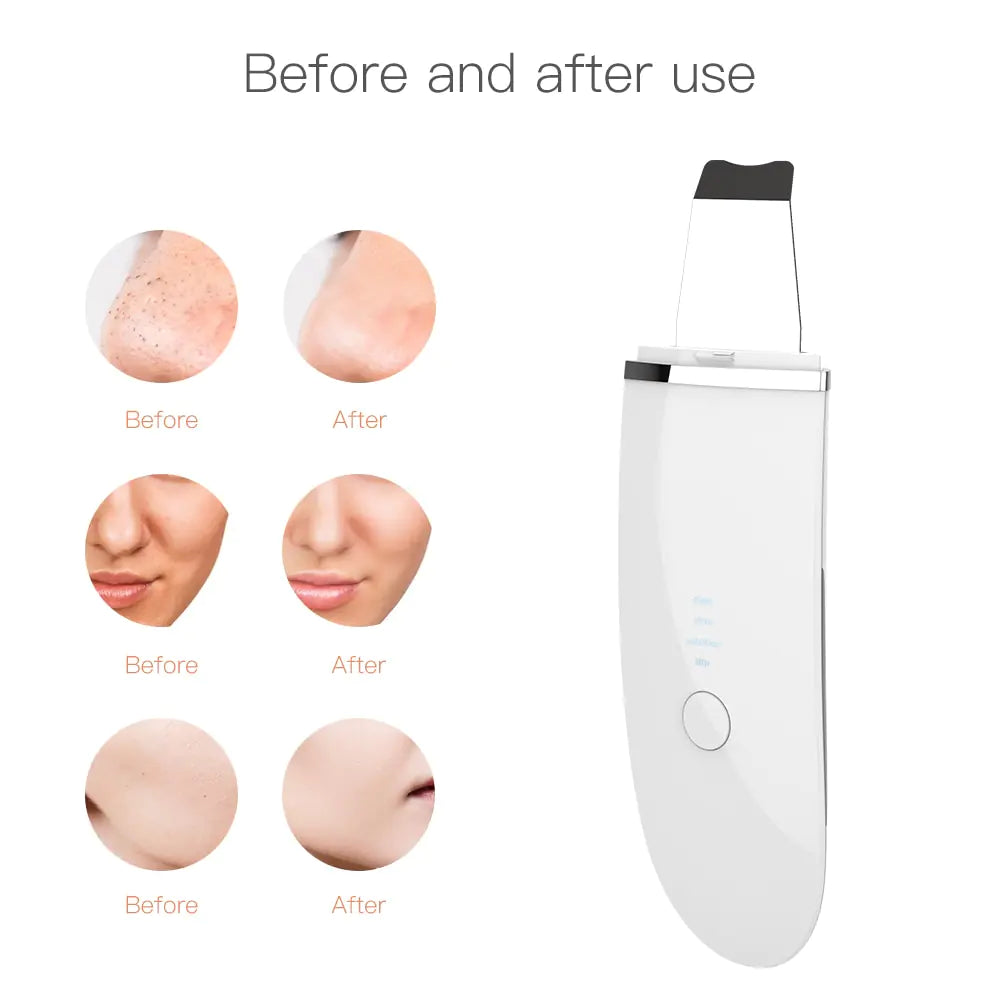 Ultrasonic Face Spatula Cleaning Skin